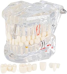 Transparent Dental Implant Teeth Model - Transparent Disease Teeth Model Pathological Tooth Model with Removable Teeth for Dental Study and Education Lvchen