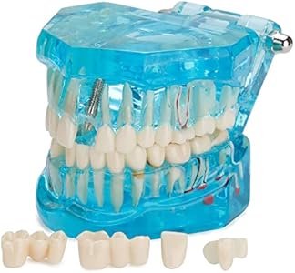 Transparent Dental Implant Teeth Model - Transparent Disease Teeth Model Pathological Tooth Model with Removable Teeth for Dental Study and Education Lvchen