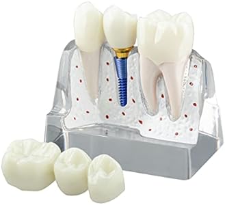 Dental Implant Model for Patient Education, 4 Times Dental Implant, Crown and Bridge Model for Presentation-Transparent Ultrassist