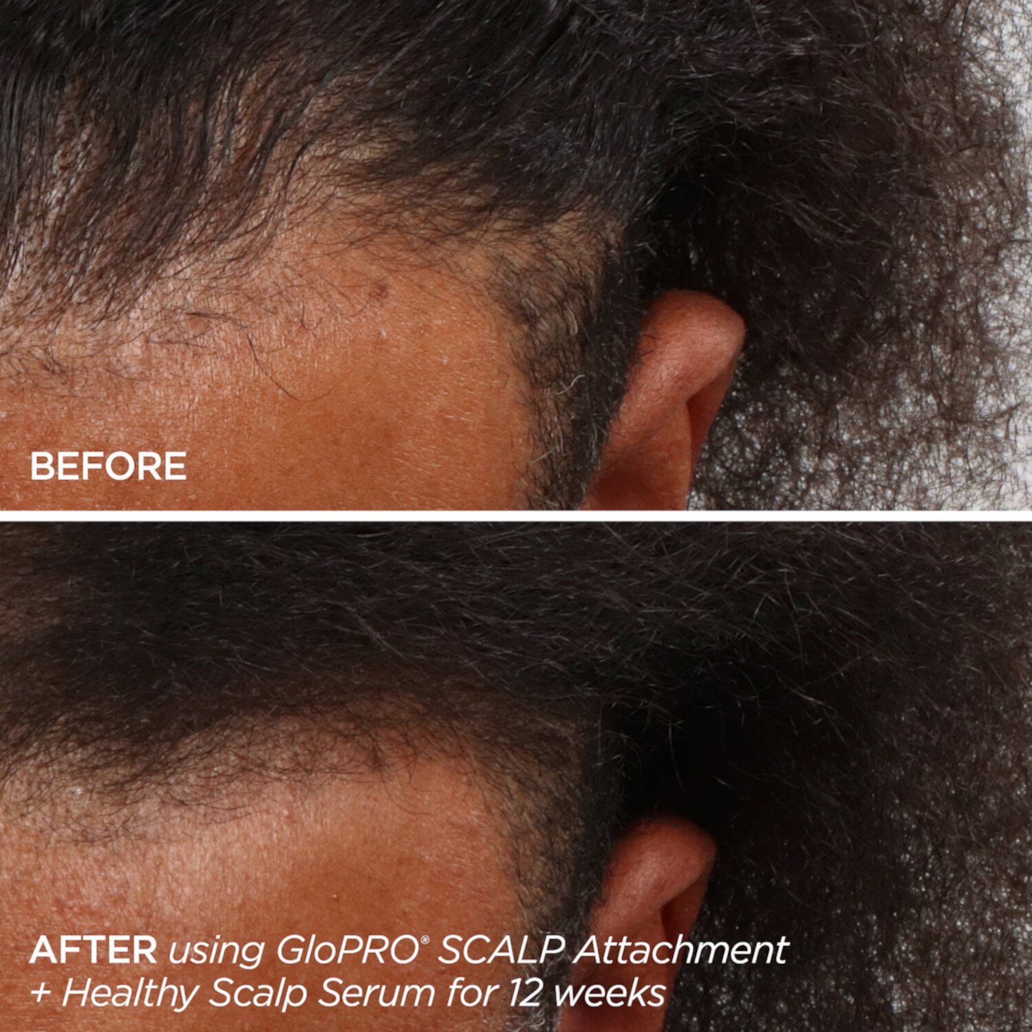 Rejuvenating Scalp + Fuller Hair Therapy Set BeautyBio