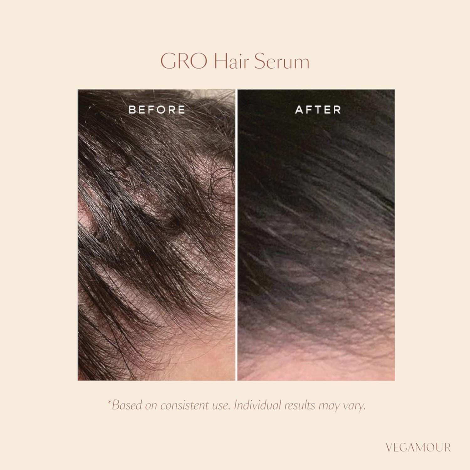 GRO Hair Serum & Biotin Gummies Set for Thinning Hair Vegamour