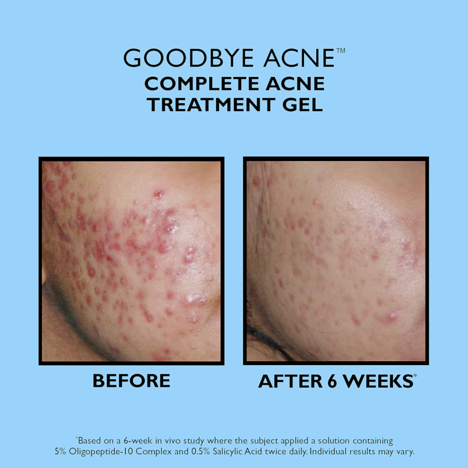 Goodbye Acne ™ Комплексный гель для лечения прыщей Peter Thomas Roth