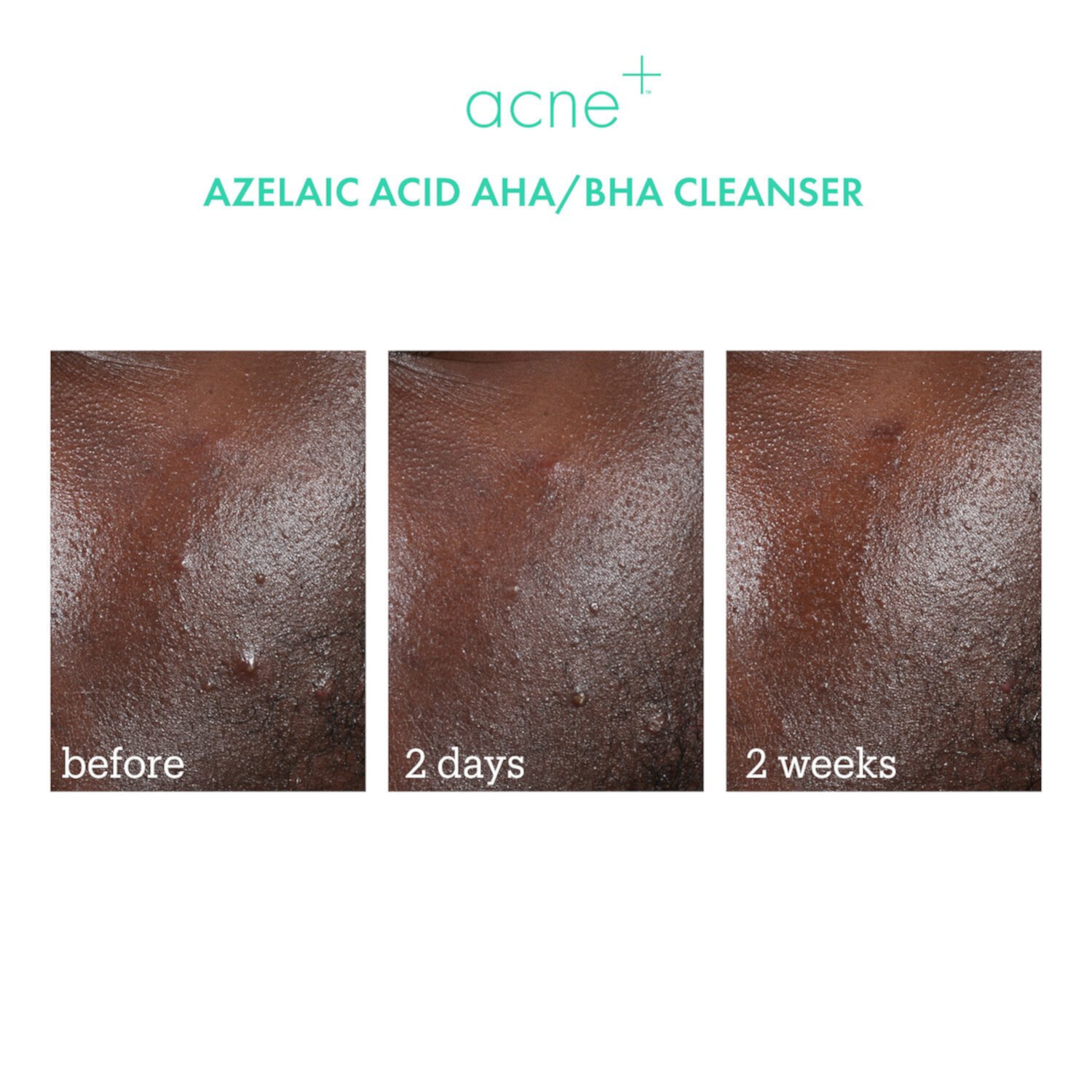 Акне+ 2% BHA + азелаиновая кислота + ниацинамид + очищающее средство с AHA Skinfix