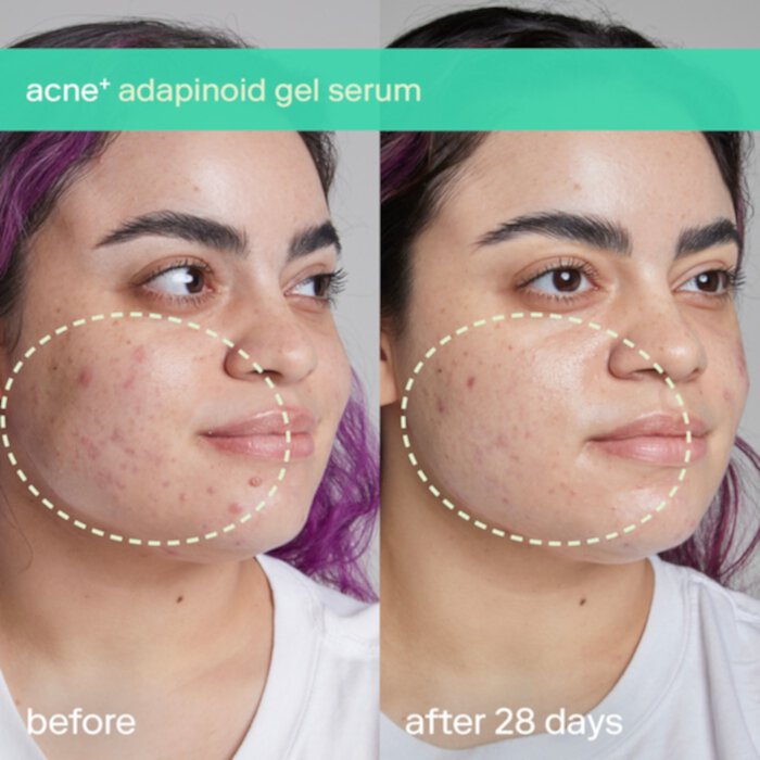 acne+ adapinoid Gel with Niacinamide + Squalane Skinfix