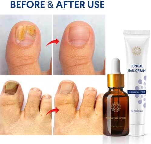 Toenail Fungus Treatment Extra Strength: Nail Fungus Treatment for Toenail and Fingernails - Fungus Nail Treatment Liquid 15ML and Anti-fungal Nail Repair Cream 20g Plant Extract Ingredients Natural Vine