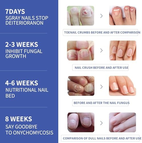 Toenail Fungus Treatment Extra Strength - Toenail Fungus Treatment, Toe Nail Fungus Treatments, Nail Fungus Treatment For Toenail, Nail Repair Solution - Safely and Gently Tree Hut