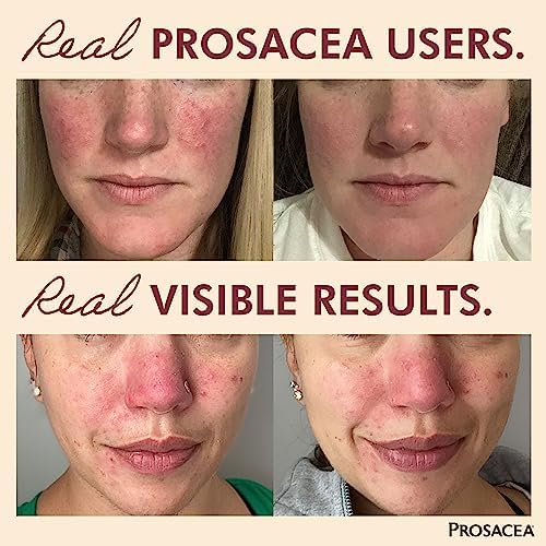 Prosacea Controls Maskne Rosacea Symptoms of Redness, Pimples & Irritation, 0.75 Oz Prosacea