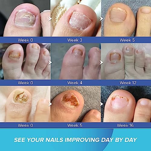 Toenail Fungus Treatment for Nail Repair: Toenail Fungus Treatment Extra Strength for Athlete's Foot of Discolored Damaged Nails Care At Home FungiFree