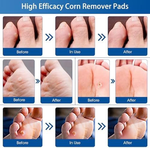 MQUPIN 48 Pcs Corn Removal Pads for Feet and Toe, Corn Feet Remover for Feet Extra Strength, Callous Remover, Wart Remover Bandaid MQUPIN