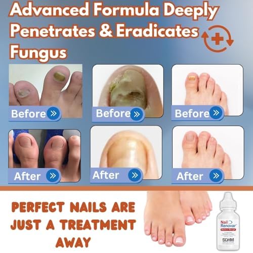 Toenail Fungus Treatment Extra Strength - FDA-Compliant,Made In USA-Toe Nail Fungus Treatments, Discolored or Brittle Nails -Nail Care Fl Oz 1.0 (30 ml) Sohm