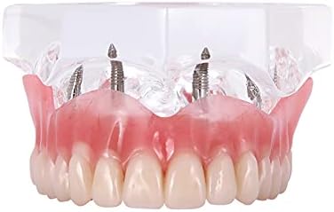 Dental Upper Implants Model Overdenture with 4 Superior Teeth Demo Transparent Vision for Education and Study Model Tool M6001 C Dentalmall