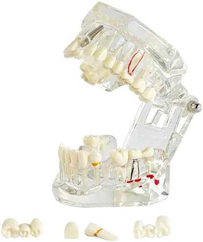 Transparent Dental Implant Model with Pathology for Educational Purposes - Demonstrative Implant Disease Teeth Model for Students and Professionals - Ideal for Dental Education and Demonstrations Ceonam