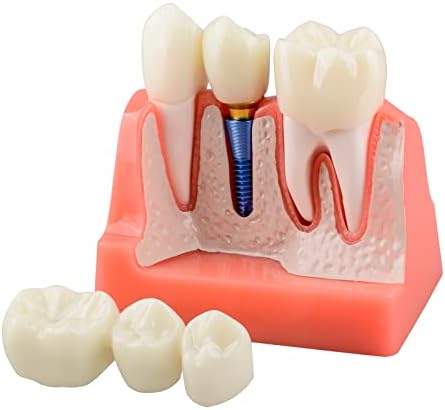 Dental Implant Model for Patient Education, 4 Times Dental Implant, Crown and Bridge Model for Presentation-Pink Ultrassist