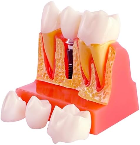 Dental Implant Model with Removable Crown Bridge - 4 Times Enlarged Demonstrative Teeth Model for Education and Study - Ideal for Class Demonstrations and Dental Student Training Ceonam