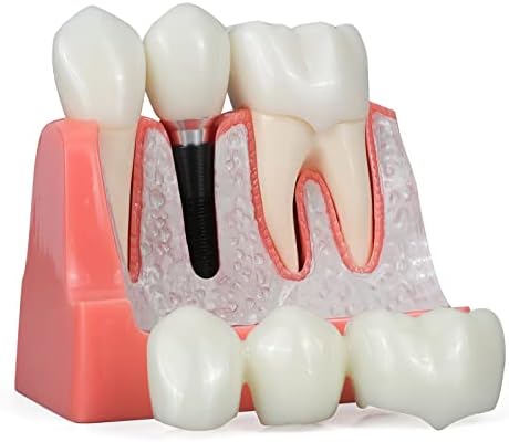 ANNWAN Dental Implant Model 4 Times Removable Analysis Crown Bridge Demonstration Teeth Model for Class Education and Studying Teeth Model Annwah