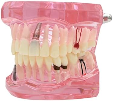 Teeth Model Teeth Typodonts Dental Implant Study Analysis Demonstration Teeth Model #2001 with Restoration Pink Dentalmall