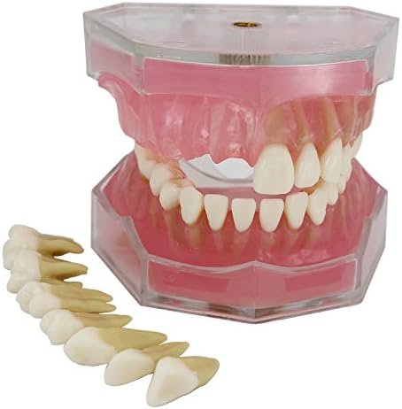 Dental Implant Teeth Model Study Teach Standard Model with Removable Teeth Smile1000